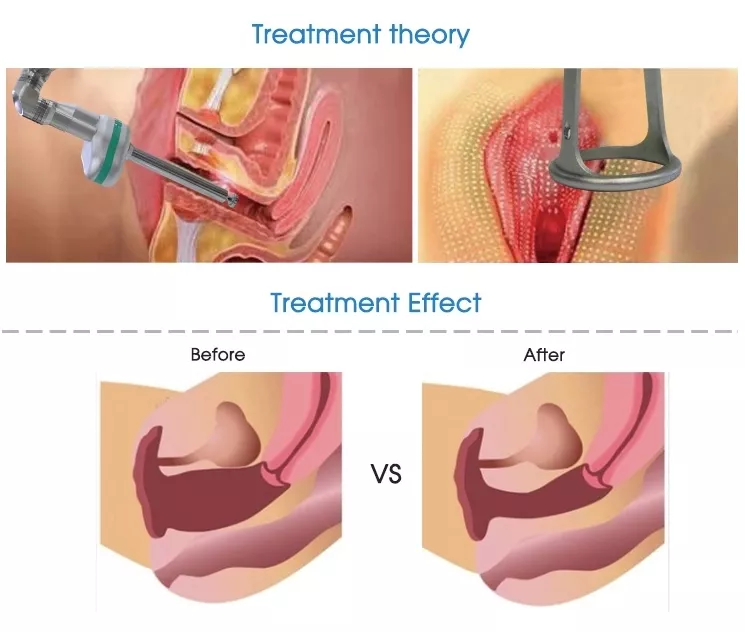 vaginal-tightening-laser